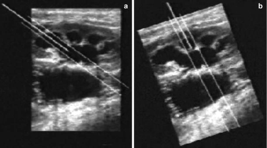 取石球囊怎么取石经皮肾镜取石术的要点_https://www.jmylbn.com_新闻资讯_第4张