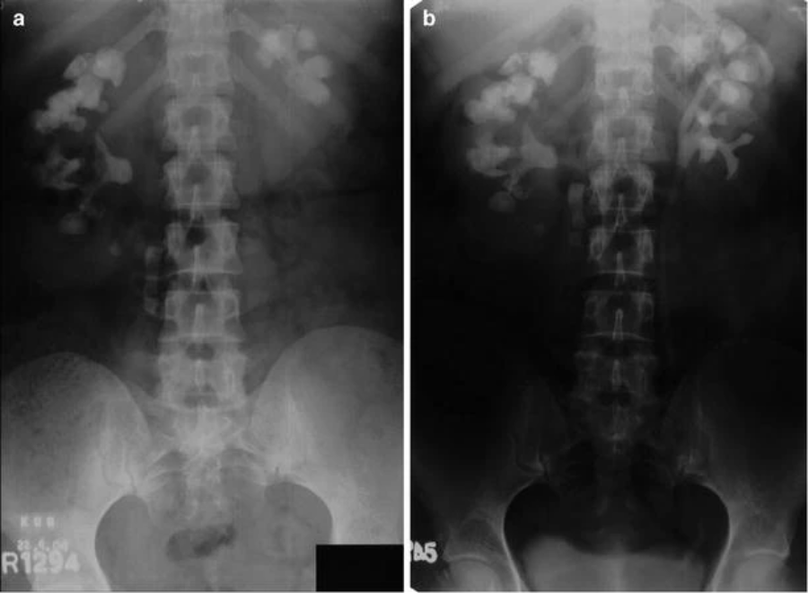 取石球囊怎么取石经皮肾镜取石术的要点_https://www.jmylbn.com_新闻资讯_第8张