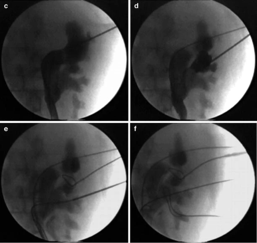 取石球囊怎么取石经皮肾镜取石术的要点_https://www.jmylbn.com_新闻资讯_第7张
