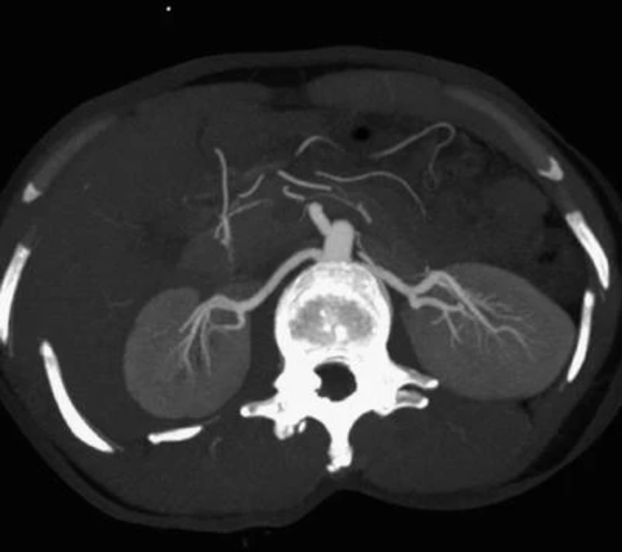 取石球囊怎么取石经皮肾镜取石术的要点_https://www.jmylbn.com_新闻资讯_第3张