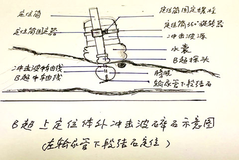 体外碎石b超怎么定位输尿管下段结石（壁间段结石）体外冲击波碎石要点_https://www.jmylbn.com_新闻资讯_第14张