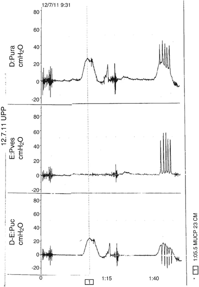 怎么看尿流量尿动力学检查_https://www.jmylbn.com_新闻资讯_第10张