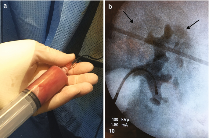 输尿管鞘是什么输尿管软镜碎石术_https://www.jmylbn.com_新闻资讯_第23张