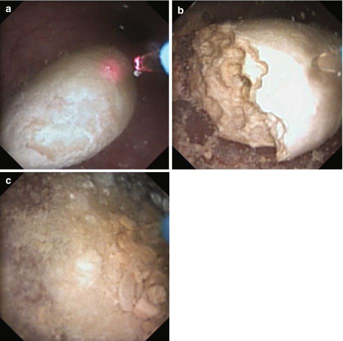 输尿管鞘是什么输尿管软镜碎石术_https://www.jmylbn.com_新闻资讯_第2张