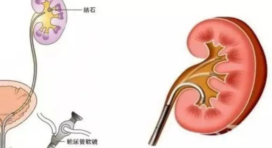 泌尿导丝怎么收费输尿管镜术：当操作变得艰难时，放置双 J 支架回家！”_https://www.jmylbn.com_新闻资讯_第1张