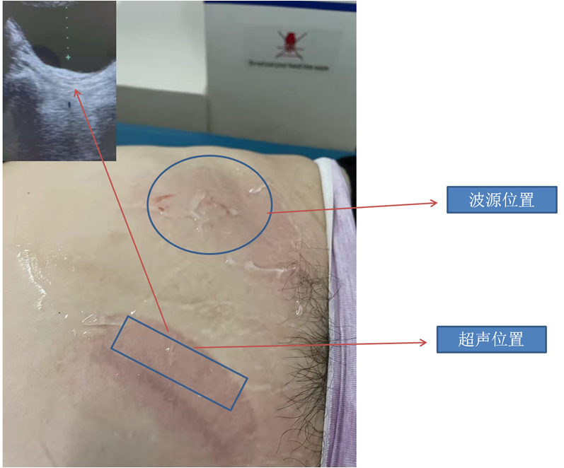体外碎石b超怎么定位输尿管下段结石（壁间段结石）体外冲击波碎石要点_https://www.jmylbn.com_新闻资讯_第11张