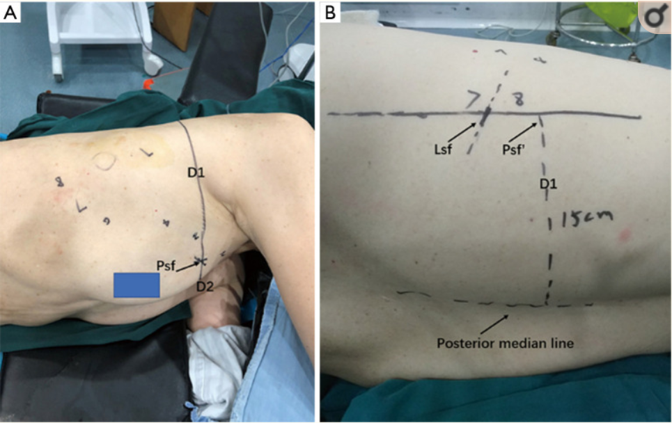 什么是数字肺膨胀肺／萎陷肺的真相：人工气胸下的支气管+肺实质数字模型与三维重建？_https://www.jmylbn.com_新闻资讯_第6张