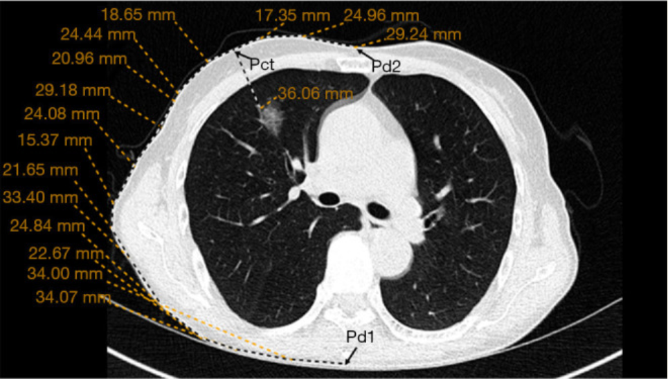 什么是数字肺膨胀肺／萎陷肺的真相：人工气胸下的支气管+肺实质数字模型与三维重建？_https://www.jmylbn.com_新闻资讯_第5张