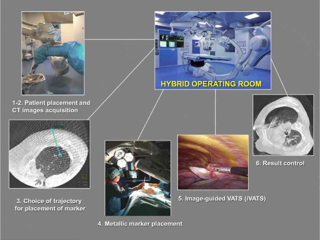 什么是数字肺膨胀肺／萎陷肺的真相：人工气胸下的支气管+肺实质数字模型与三维重建？_https://www.jmylbn.com_新闻资讯_第9张
