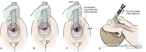 气管插管牙垫怎么放气管插管术具体流程_https://www.jmylbn.com_新闻资讯_第13张