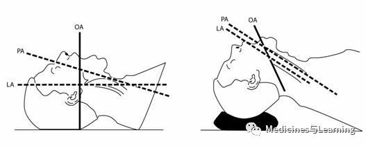 气管插管牙垫怎么放气管插管术具体流程_https://www.jmylbn.com_新闻资讯_第9张