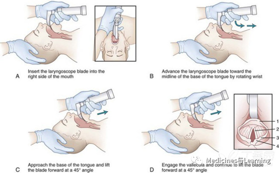 气管插管牙垫怎么放气管插管术具体流程_https://www.jmylbn.com_新闻资讯_第12张