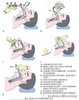 气管插管牙垫怎么放气管插管术具体流程_https://www.jmylbn.com_新闻资讯_第18张
