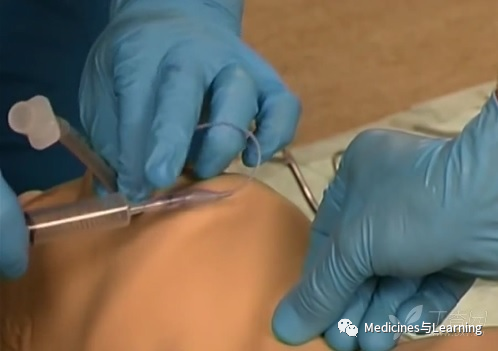 气管插管牙垫怎么放气管插管术具体流程_https://www.jmylbn.com_新闻资讯_第17张