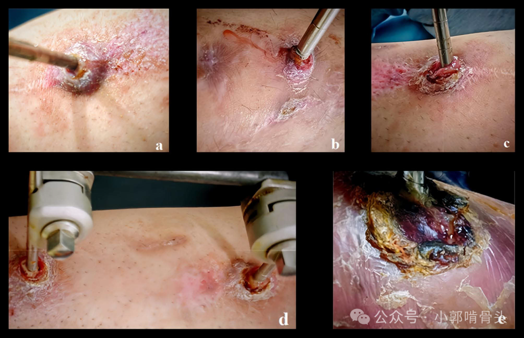 医用钢针是什么骨科精读 ｜ 医用橡胶塞减少外固定针钉道感染_https://www.jmylbn.com_新闻资讯_第7张