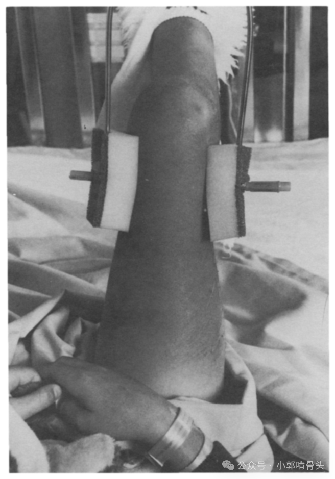 医用钢针是什么骨科精读 ｜ 医用橡胶塞减少外固定针钉道感染_https://www.jmylbn.com_新闻资讯_第12张