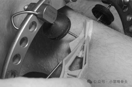 医用钢针是什么骨科精读 ｜ 医用橡胶塞减少外固定针钉道感染_https://www.jmylbn.com_新闻资讯_第15张