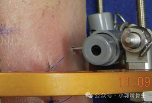 医用钢针是什么骨科精读 ｜ 医用橡胶塞减少外固定针钉道感染_https://www.jmylbn.com_新闻资讯_第10张