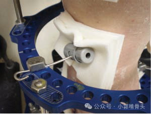 医用钢针是什么骨科精读 ｜ 医用橡胶塞减少外固定针钉道感染_https://www.jmylbn.com_新闻资讯_第9张