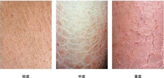 湿疹就是湿气重吗？你对湿疹的误会那么多 – 文章管理后台