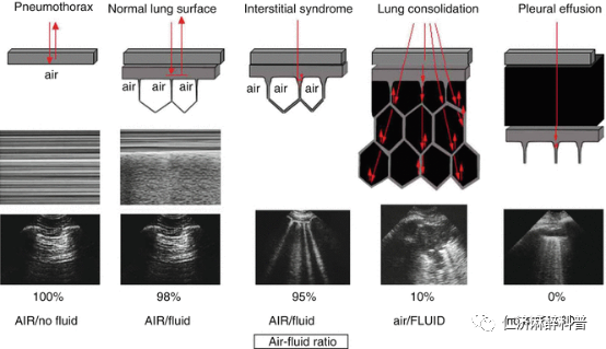 床旁x怎么使用床旁肺部超声检查_https://www.jmylbn.com_新闻资讯_第2张