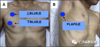 床旁x怎么使用床旁肺部超声检查_https://www.jmylbn.com_新闻资讯_第4张