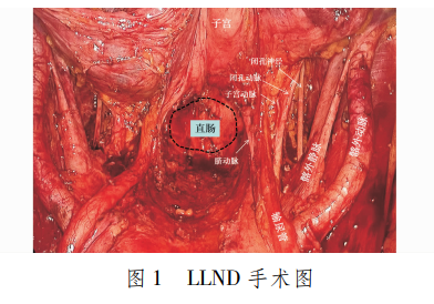 双极刀怎么画专家论坛｜ 超声刀联合双极电凝在腹腔镜直肠癌盆腔侧方淋巴结清扫中的应用效果评价_https://www.jmylbn.com_新闻资讯_第3张
