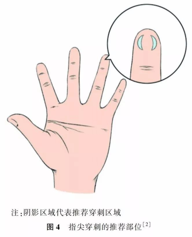 儿童末梢采血针有哪些一文带你读懂儿童末梢采血_https://www.jmylbn.com_新闻资讯_第14张