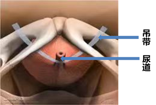 尿道张力过强怎么办【女性】经闭孔无张力尿道中段悬吊带术  让生活不再被尿失禁困扰_https://www.jmylbn.com_新闻资讯_第6张