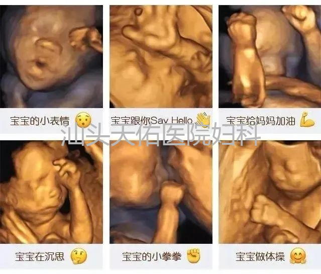 汕头彩超怎么样四维小科普 4 问 4 答，你不清楚的都在这篇推文里！『汕头市妇产医院』_https://www.jmylbn.com_新闻资讯_第3张