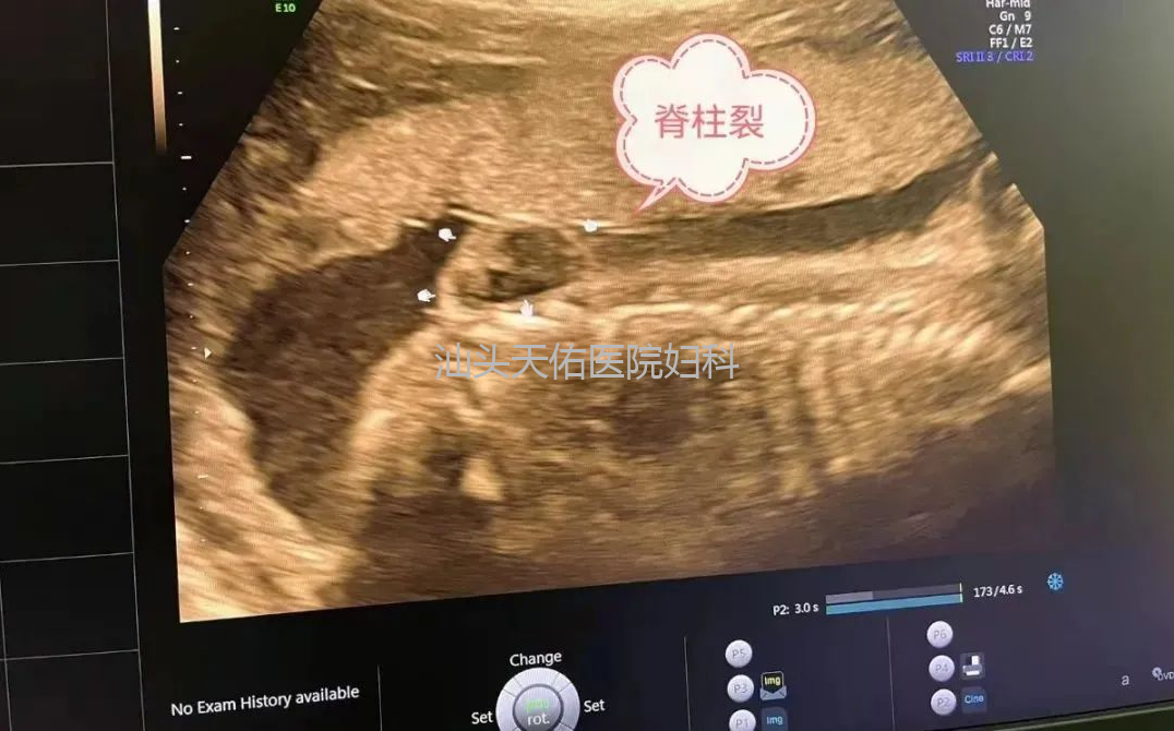 汕头彩超怎么样四维小科普 4 问 4 答，你不清楚的都在这篇推文里！『汕头市妇产医院』_https://www.jmylbn.com_新闻资讯_第6张