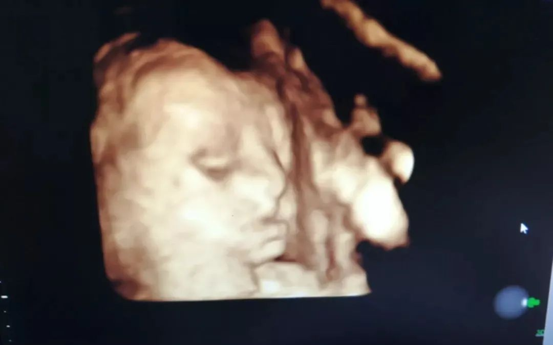 汕头彩超怎么样四维彩超啥时候预约？它检查什么？看了这篇全明白！『汕头妇产科医院』_https://www.jmylbn.com_新闻资讯_第3张