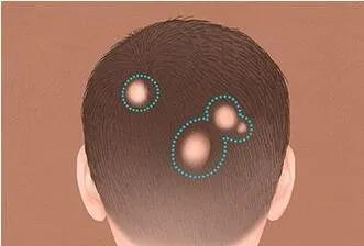 斑秃这样能快速恢复正常！！！