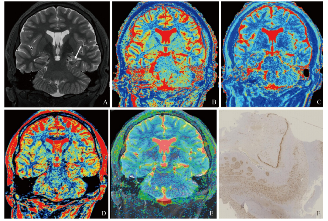 联磁共振是什么中枢神经影像学 ｜ 陈兵：集成磁共振联合高分辨率扩散加权成像在海马硬化型颞叶内侧癫痫中的应用_https://www.jmylbn.com_新闻资讯_第10张
