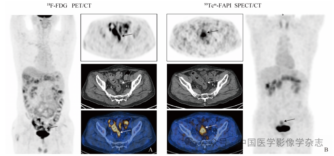 d-spect怎么检查【腹部影像学】陈文新教授团队：99Tcm-FAPI SPECT／CT对晚期结直肠癌诊断效能及免疫治疗决策的影响_https://www.jmylbn.com_新闻资讯_第9张