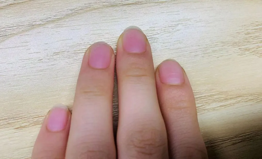 手指甲黑青是什么原因
