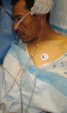 怎么拔鼻腔引流管胃管术（二）_https://www.jmylbn.com_新闻资讯_第23张