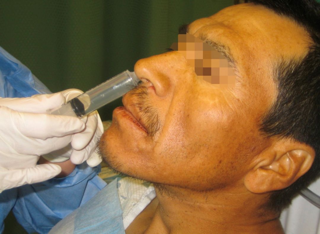 怎么拔鼻腔引流管胃管术（二）_https://www.jmylbn.com_新闻资讯_第22张