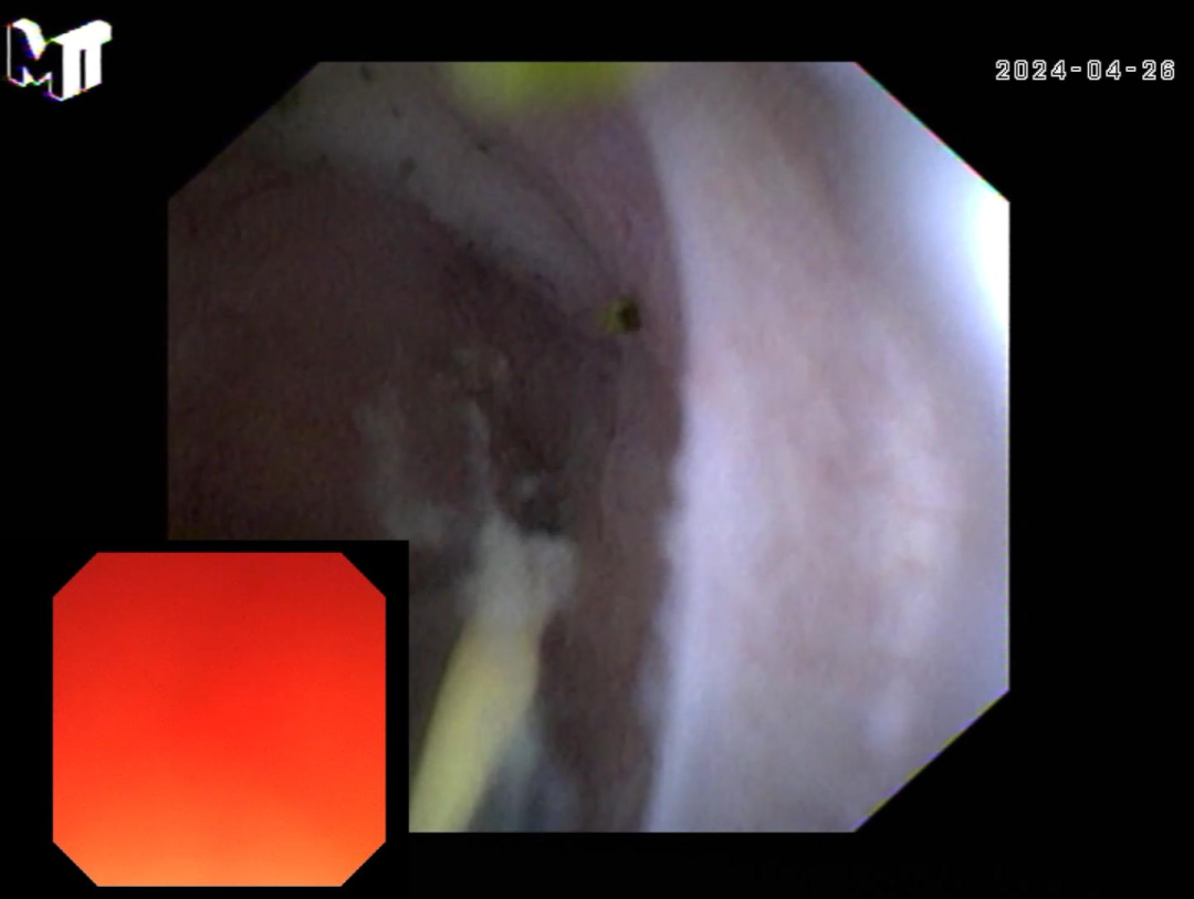 胆什么导管新技术！新型超细可视导管，打开肝胆新“视界”~_https://www.jmylbn.com_新闻资讯_第9张