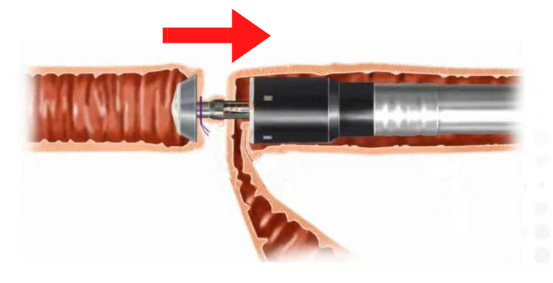 吻合器怎么用柳叶邂逅 ｜ 吻合器专题一：一次性使用管形吻合器操作要点_https://www.jmylbn.com_新闻资讯_第7张