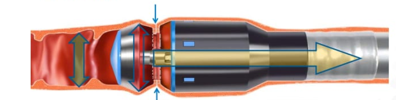 吻合器怎么用柳叶邂逅 ｜ 吻合器专题一：一次性使用管形吻合器操作要点_https://www.jmylbn.com_新闻资讯_第15张