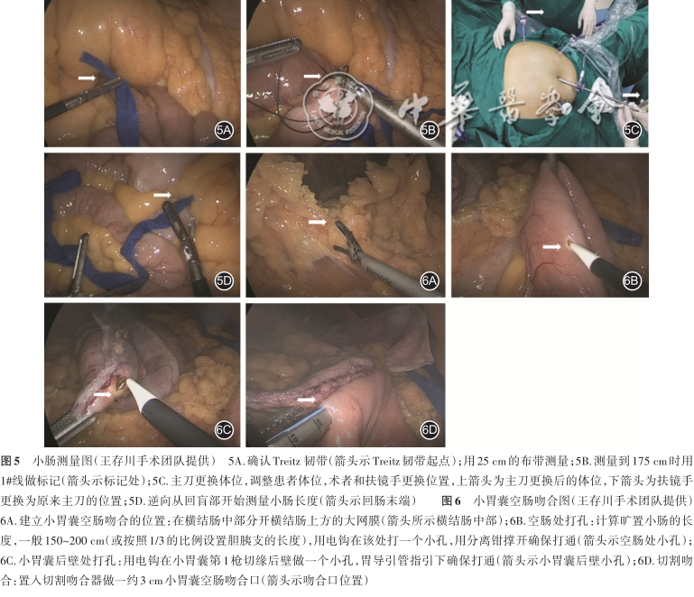 胃肠吻合需要哪些器械【指南与共识】腹腔镜单吻合口胃旁路术规范化手术操作指南（2022版）_https://www.jmylbn.com_新闻资讯_第5张