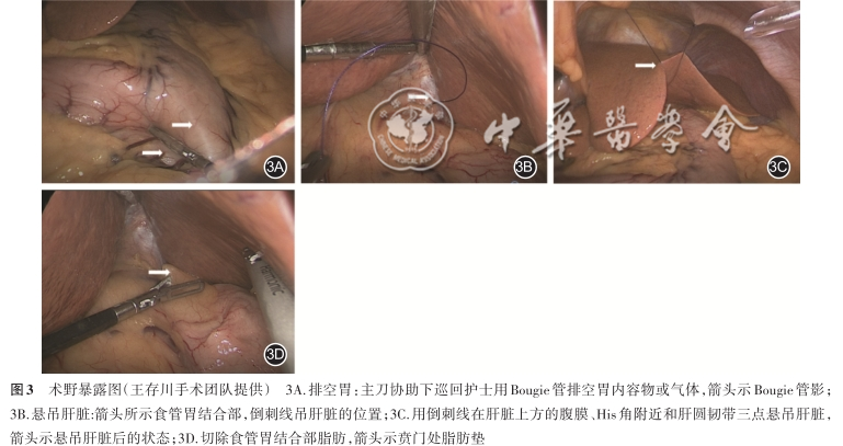 胃肠吻合需要哪些器械【指南与共识】腹腔镜单吻合口胃旁路术规范化手术操作指南（2022版）_https://www.jmylbn.com_新闻资讯_第3张