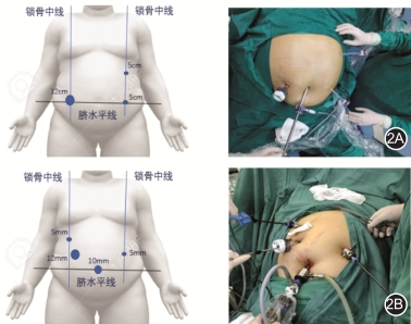 胃肠吻合需要哪些器械【指南与共识】腹腔镜单吻合口胃旁路术规范化手术操作指南（2022版）_https://www.jmylbn.com_新闻资讯_第2张