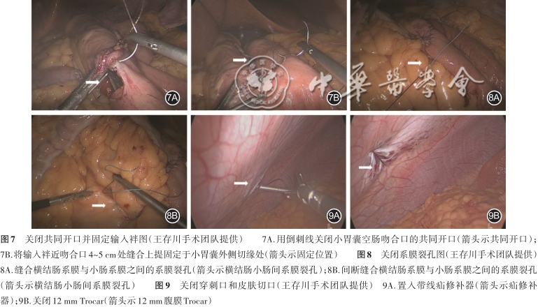 胃肠吻合需要哪些器械【指南与共识】腹腔镜单吻合口胃旁路术规范化手术操作指南（2022版）_https://www.jmylbn.com_新闻资讯_第6张