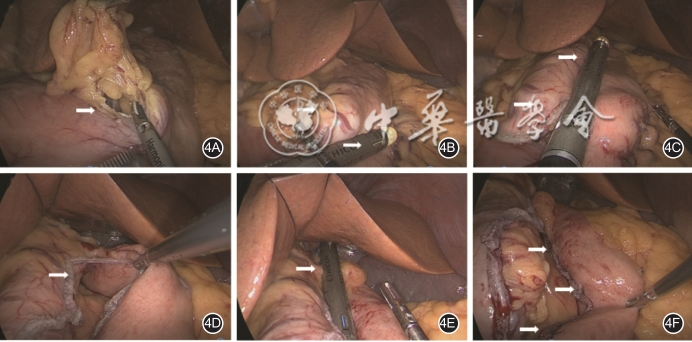 胃肠吻合需要哪些器械【指南与共识】腹腔镜单吻合口胃旁路术规范化手术操作指南（2022版）_https://www.jmylbn.com_新闻资讯_第4张