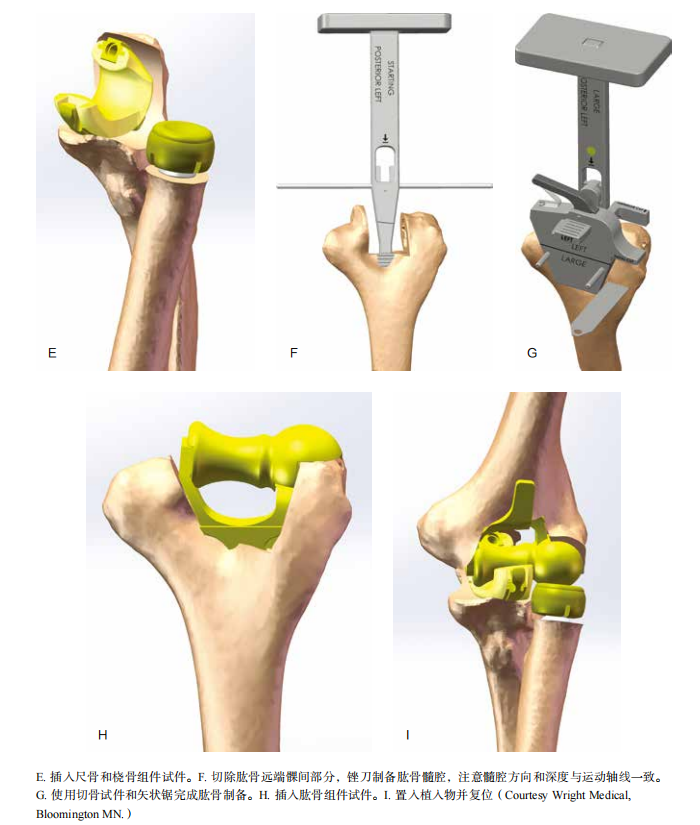 肘关节康复器怎么用全肘关节置换术--AAOS骨科术后康复指南_https://www.jmylbn.com_新闻资讯_第6张
