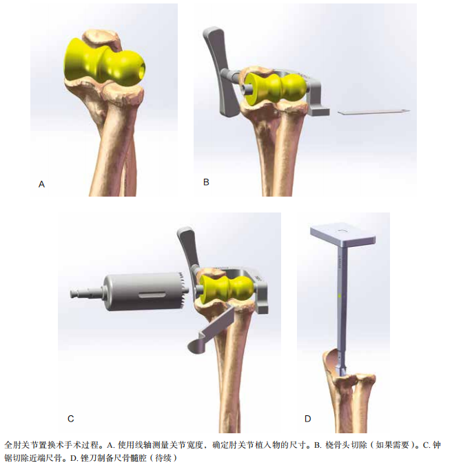 肘关节康复器怎么用全肘关节置换术--AAOS骨科术后康复指南_https://www.jmylbn.com_新闻资讯_第5张