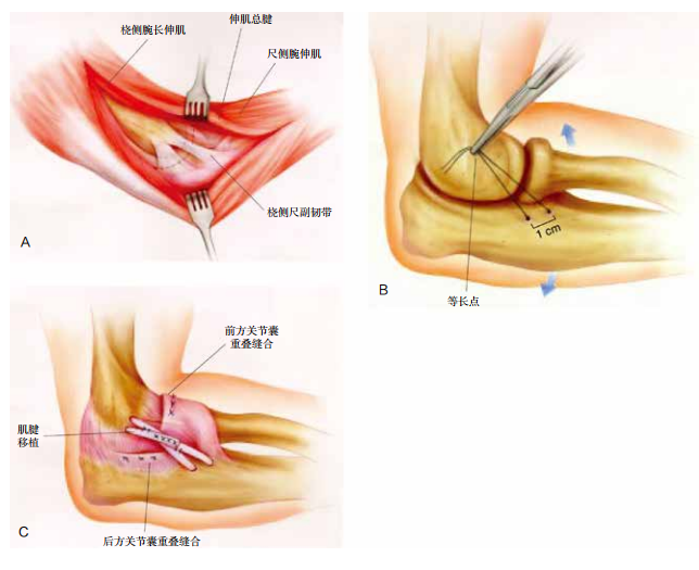 肘关节固定支具怎么用肘关节脱位切开复位内固定术后康复：AAOS骨科术后康复指南_https://www.jmylbn.com_新闻资讯_第5张
