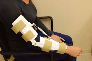 肘关节固定支具怎么用肘关节脱位切开复位内固定术后康复：AAOS骨科术后康复指南_https://www.jmylbn.com_新闻资讯_第16张